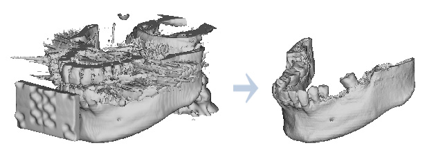 アーチファクトが除去されたきれいな3D像