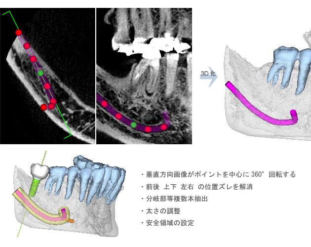 操作性抜群の下顎管抽出機能