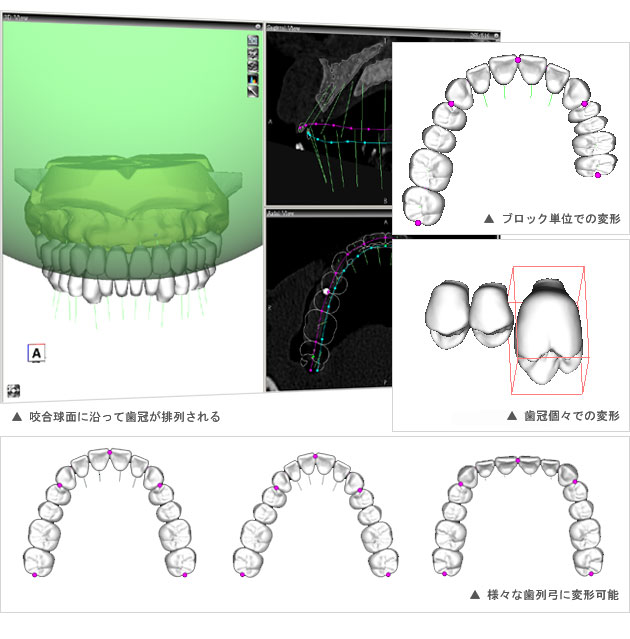 モンソンの球面説に基づく新しい歯冠排列