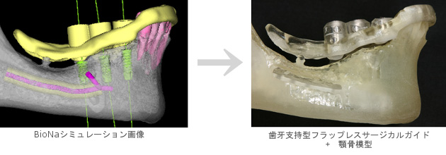 フラップレスガイド